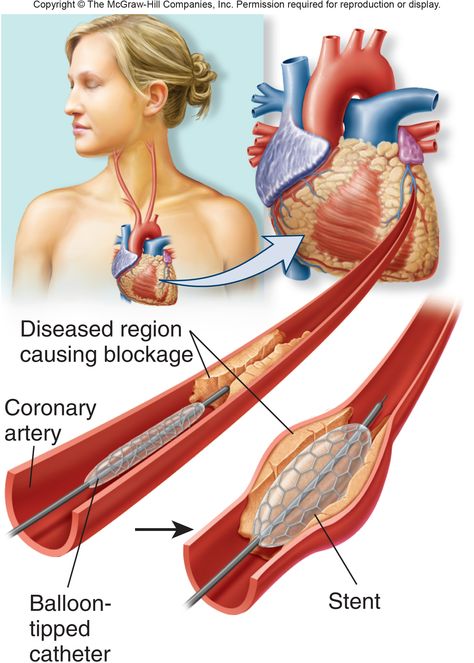 Stent in heart Cheer Picture Poses, Coronary Arteries, Cheer Pictures, Healthy Ideas, Picture Poses, Disease, Medical