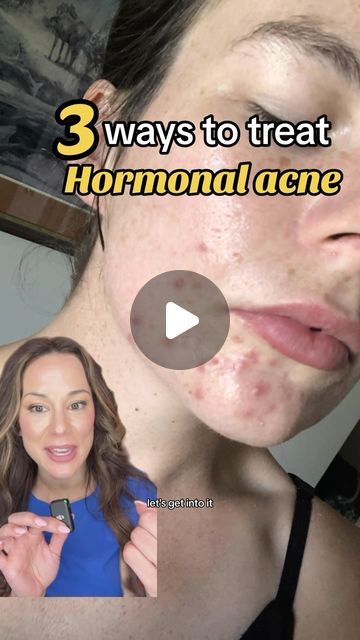 Tips To Get Rid Of Pimples, Face Mask To Remove Acne, Jawline Acne How To Get Rid Of, Acne Around Mouth And Chin, Hormonal Chin Acne, How To Treat Hormonal Acne, Hormonal Acne Tips, Types Of Acne And How To Treat, How To Get Rid Of Hormonal Acne