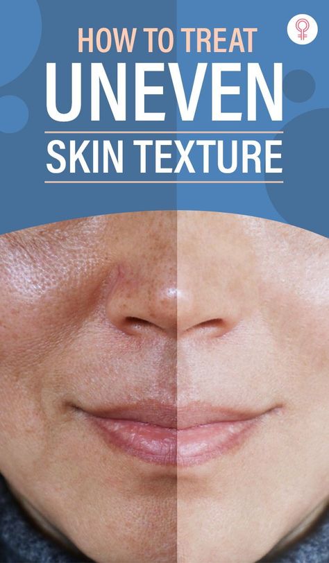 What To Use For Uneven Skin Tone, What Helps Textured Skin, Skin Texture Remedies, How To Get Even Tone Skin, How To Treat Uneven Skin Tone, Improving Skin Texture, Blotchy Skin Remedies, Skin Issues On Face, How To Smooth Skin Texture