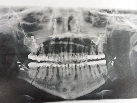 Bionic woman. Jaw xray. Maxillofacial Surgery. Jaw surgery. Kidney Tumor, Extra Teeth, Xray Art, X-ray Images, Pregnant Cat, Jaw Surgery, Rare Disorders, X Rays, Natural Background