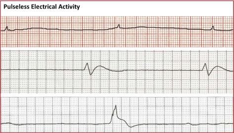 pulseless-electrical-activity Acls Study Guide 2022, Acls Study Guide, Acls Test, Medications Nursing, Nursing Things, Perioperative Nursing, Pr Interval, Study Info, Medical Study