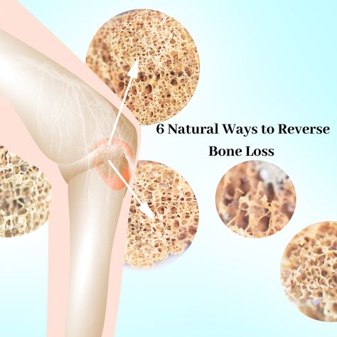 Bone loss can happen silently. And then, you get a diagnosis of osteopenia or osteoporosis. Learn more about bone loss and what you can do to control it. Bone Healing Foods, Osteoporosis Exercises, Bone Healing, Dry Bones, Poor Nutrition, Bone Loss, Health And Wellness Coach, Vitamin K2, Bone Density