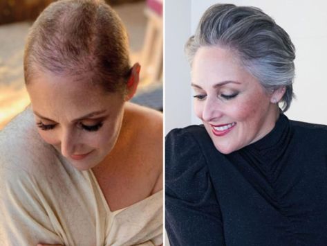 Ricki Lake, Lake Hair Styles, Female Pattern Baldness, Androgenetic Alopecia, Shave Her Head, Dramatic Hair, Pattern Baldness, Female Hair, Thinning Hair