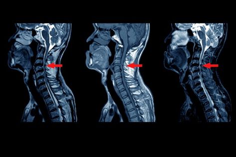 Mri Spine, Spine Injury, Human Skeletal System, Skull Human, Intervertebral Disc, When To Plant Vegetables, Concept Draw, Disease Symptoms, Cervical Spine