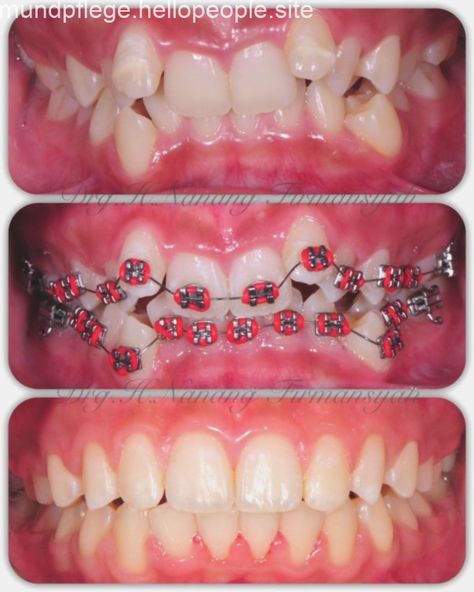 Teeth After Braces, Braces Transformation, Invisible Teeth Braces, Happy Dental, Braces Tips, Dental Posters, Dental Videos, Invisible Braces, Dental Photography