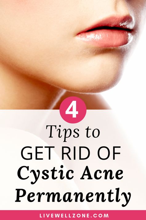 Get Rid Of Hormonal Acne, Get Rid Of Cystic Acne, Acne Diet Plan, Nodule Acne, Hormonal Acne Diet, Hormonal Acne Supplements, Acne Supplements, Treating Cystic Acne, Hormonal Acne Remedies