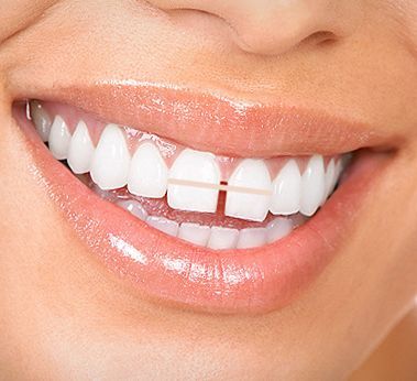 Get rid of the gap between your teeth without braces Small Gap In Teeth, Gap Grillz, Gapped Teeth, Teeth Gap, Space Between Teeth, Fix Teeth, Tooth Repair, Kedokteran Gigi, Diamond Teeth