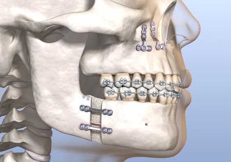 Jaw surgery, also known as orthognathic surgery or corrective jaw surgery, corrects misalignment of the jaw bones. It also helps with activities like chewing and swallowing. Orthognathic surgery can even improve your profile and facial appearance. Jaw Surgery Aesthetic, Maxillofacial Surgery Wallpaper, Jaw Surgery Before And After Overbite, Orthognathic Surgery Before And After, Jaw Surgery Before And After, Corrective Jaw Surgery, Double Jaw Surgery, Facial Aesthetic, Dental Animation