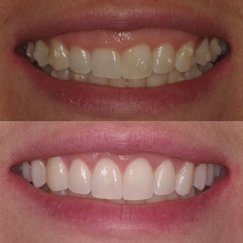 This was a diagnosis of delayed passive eruption was determined & able to treat the teeth with conservative #aesthetic #crownlengthening to achieve a #beautiful result which is stable & long lasting. #smiledesign #lovethegumsyourewith #gotoapro #gummysmile #gummysmilecorrection Orthodontic Aesthetic, Gummy Smile Aesthetic, Conservative Aesthetic, Gummy Smile Correction, Short Teeth, Teeth Aesthetic, Cosmetic Dentistry Procedures, Pretty Teeth, Jaw Surgery