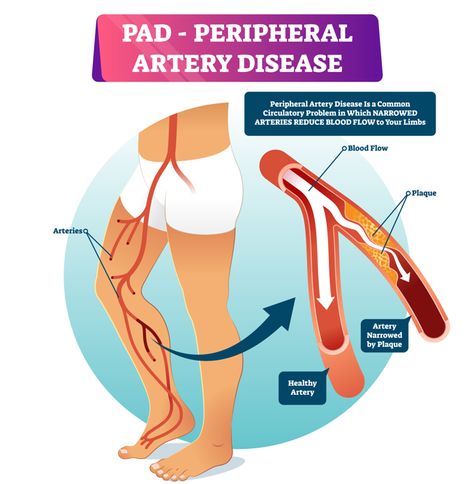 Brain Fog Causes, Peripheral Artery, Vascular Ultrasound, Body Diagram, Cold Medicine, Lower Your Cholesterol, The Dating Divas, Light Exercise, High Cholesterol