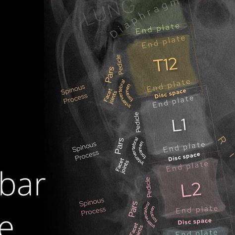 the Radiologist | Radiology on Instagram: "Read on for a system to assess the lumbar spine lateral X-ray⁣ ⁣ L-SPINE LATERAL X-RAY⁣ 1️⃣Assess alignment. Check that all of the lumbar spine vertebrae line up with each other and one isn’t displaced either forwards or backwards (spondylolisthesis)⁣ ⁣ 2️⃣Outline the vertebral bodies checking height is maintained and there is no endplate disruption suggesting fracture or erosion⁣ ⁣ 3️⃣Look at the disc spaces - have these lost height? The most common re Spine Vertebrae, Medical Radiography, Intervertebral Disc, Lumbar Spine, Rad Tech, Physician Assistant, Med Student, Med School, Medical Students