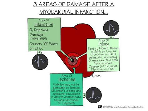 Myocardial infarction Myocardial Ischemia, Cardiovascular Nursing, Medications Nursing, Medical Things, Nursing Information, Nursing Fun, Med Surg Nursing, Staff Development, Nursing Mnemonics