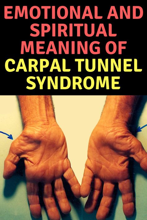 Herbs For Carpal Tunnel, Carpal Tunnel Exercises After Surgery, Carpultunal Exercise, Exercises For Carpal Tunnel Hands, How To Help Carpal Tunnel, Carpal Tunnel Release Surgery Recovery, Carple Tunnel Symptoms, Carpel Tunnel Exercises, Carpoltunal Relief Hands