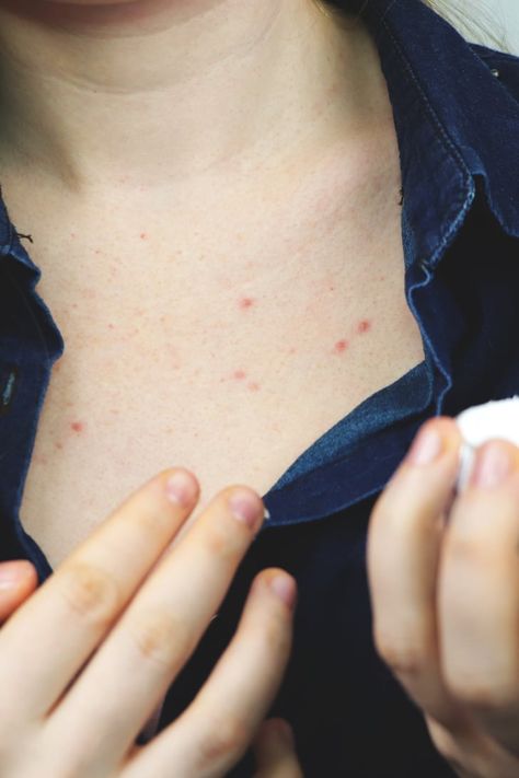 How to Treat Chest Acne, According to Dermatologists Shoulder Acne, Back Acne Remedies, Chest Acne, Forehead Acne, Prevent Pimples, Natural Acne Remedies, How To Get Rid Of Pimples, Body Acne, Popsugar Beauty