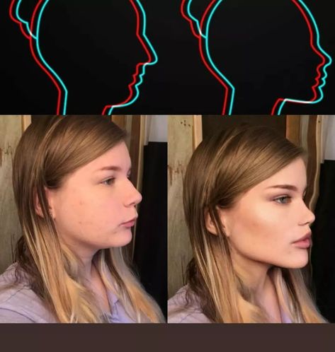 AESTHETICS ❄️ on Instagram: “Facial Forward Growth Another example of what is considered classical beauty or what you would find pinned as attractive by the classical…” Jaw Reduction Surgery, Face Plastic Surgery, Change Appearance, V Line Surgery, Plastic Surgery Fail, Korean Plastic Surgery, Plastic Surgery Gone Wrong, Face Surgery, Classical Beauty