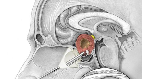 Why It’s Safer Than Ever To Remove Pituitary Tumors | CushieBlog Neurosurgery Study, Pituitary Gland Tumor, Pituitary Tumor, Longevity Diet, Human Tissue, Low Estrogen Symptoms, Carotid Artery, Low Estrogen, Pituitary Gland