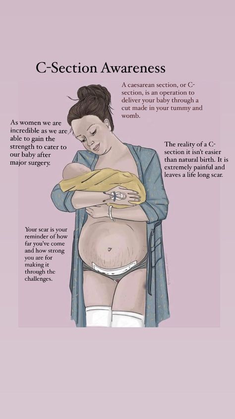 C Section Recovery Quotes, C Section Art, C Section Quotes Inspiration, C Section Awareness Month Quotes, C Section Affirmations, C Section Mom Quotes, Pregnancy Journey Quotes, Post Partum Quotes Mothers, C Section Quotes