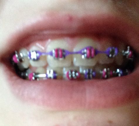 Cute braces ideas- Pink & Orchid Braces Ideas, Cute Braces, Brace Face, Braces Colors, Girls Y2k, Pink Orchids, Pink Neon, Pinkie Pie, Rainbow Dash