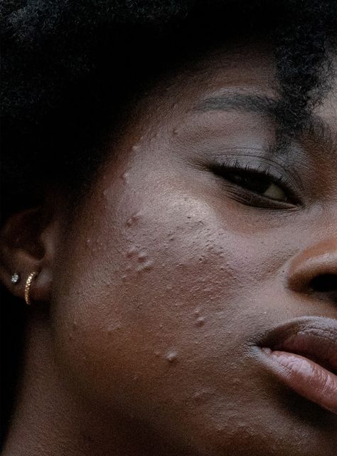 How To Approach Acne, Hyperpigmentation & Sun Damage, According To A Beauty Expert+null Hyperpigmentation Black Skin, Acne Women, Acne Hyperpigmentation, Skin Aesthetics, Beauty Hacks Skincare, Sun Damaged Skin, Beauty Vitamins, Laser Therapy, Acne Spots