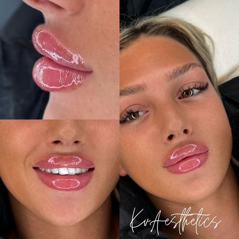 Katherine Victoria on Instagram: "Bratz Doll Lips 💋  @caitlinsherwoodx   This Is Your Sign 💫 1ml Refresh 💞  Sunderland Aesthetics @kvaestheticsuk   Get booked In This Week 📲  Refresh Starting From £100   ✨✨✨Thank you EVERYONE for spreading your positive vibes out there. ✨✨✨" Bratz Lip Filler, Bratz Doll Lip Filler, Doll Lips Filler, Bratz Doll Lips, Russian Lips Filler, Bratz Lips, 1ml Lip Filler, Doll Lips, Lips Fillers