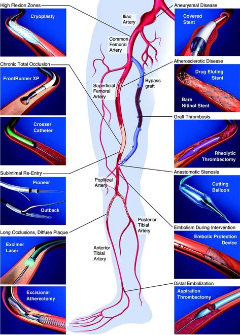 Effective home remedies for the natural elimination of varicose veins Medical Sonography Student, Cath Lab Nursing, Diagnostic Medical Sonography Student, Ultrasound School, Cardiac Sonography, Medical Terminology Study, Vascular Ultrasound, Sonography Student, Medical Sonography