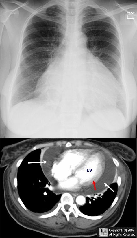 Pericardial effusion. Frontal chest radiograph (above) demonstrates a markedly enlarged cardiac silhouette. The differential diagnosis would include cardiomyopathy and pericardial effusion. A single axial, contrast-enhanced CT scan of the chest at the level of the heart shows a large pericardial effusion (white arrows) surrounding the contrast-filled heart. The red arrow points to the myocardium. Chest Ct Scan, Heart Xray, Heart Scan, Cardiac Tamponade, Bottle Silhouette, Pericardial Effusion, Radiologic Technology, Enlarged Heart, Differential Diagnosis