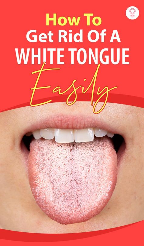 Sore Tongue Remedy, Mouth Sore Remedy How To Get Rid, Dry Mouth Remedies How To Get Rid, Dry Mouth Remedies, Cracked Tongue, Clean Tongue, Get Rid Of Candida, Remedies For Dry Mouth, White Tongue