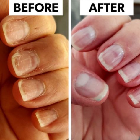 Ready to ditch your acrylics, dips, and gels and grow your own natural nails? Rocket Nail Fuel is helping 1,000s of people achieve nail growth and strength they never thought possible. How to use our Rocket Nail System: * 1 base coat of Clear Nail Fuel * 2 coats of Rocket Color * 1 top coat of clear Nail Fuel - Wait 24hrs- * Layer Clear Nail Fuel daily for 5 - 7 days Strengthening Nail Polish, Nail Overlay, Do It Yourself Nails, Nail Remedies, Peeling Nails, Nail Repair, Damaged Nails, How To Grow Nails, Brittle Nails