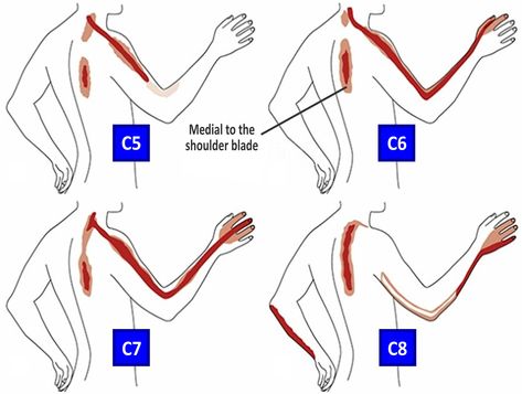 Cervical radiculopathy is a disease process marked by nerve compression, typically from herniated disc material or arthritic bone spurs in the neck. Symptoms typically include pain, weakness, or numbness in the areas served by the affected nerve. Pain can be felt in one area only, like the shoulder, or progress along the entire arm and into the hand and fingers - in the same way that knocking your “funny bone” causes symptoms at the site, and further along the length of the ulnar nerve. Punkty Spustowe, Cervical Disc, Cervical Pain, Referred Pain, Disk Herniation, Pinched Nerve, Spine Health, Neck And Shoulder Pain, Hand Therapy