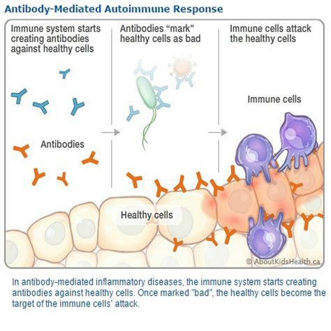 Autoimmune Encephalitis Autoimmune Encephalitis, Brain Disorders, Brain Diseases, Brain Tissue, Disease Symptoms, Vision Loss, Nerve Cell, Rare Disease, Healthy Brain