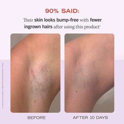 A pack of go-to, single-use pads to effectively combat angry razor burn and painful ingrown hairs while stopping more from popping up. Feminine Hygiene Routine, Razor Burn, Ingrown Hairs, Razor Burns, Hygiene Routine, Feminine Hygiene, First Aid Beauty, Ingrown Hair, First Aid