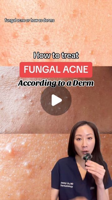 Jenny Liu, MD FAAD , Skincare expert on Instagram: "Tips for managing “fungal acne”:

Start with an anti-dandruff shampoo, use like a cleanser/body wash, leave on for few minutes then rinse off. Topical otc anti fungal creams may also be benefits 

However often the pityrosporum yeast is deeper in the hair follicles and require a course of oral medication for best response 

Drop any questions you have below 

#pityrosporumfolliculitis #fungalacne #acnecommunity #acnetips #dermatologist" How To Clear Fungal Acne Naturally, Dandruff Shampoo For Acne, Nizoral For Fungal Acne, How To Treat Fungal Acne, Fungle Acne, Fungal Acne Skin Care Routine, Best Cream For Acne, Comedonal Acne, Cream For Acne