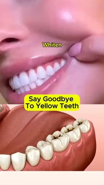 How To Whiten Teeth, Natural Teeth Whitening Diy, Natural Teeth Whitening Remedies, Teeth Remedies, Beauty Treatments Skin Care, Teeth Whitening Homemade, Dark Lip, Teeth Whitening Remedies, Teeth Whitening Diy