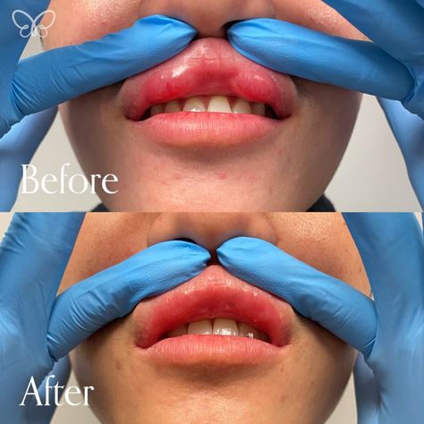 Removed 2 lip bumps from upper lip Filler Migration Lips, Migrated Lip Filler, Facial Swelling, Abdominal Stretches, Botox Before And After, Facial Fillers, Skin Bumps, Cosmetic Injectables, Lip Augmentation