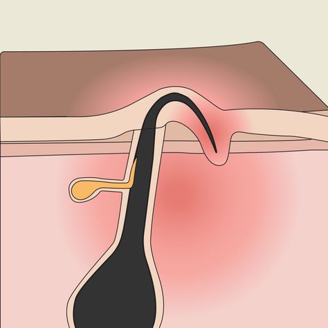 Banish the discomfort of ingrown hairs with our step-by-step guide to effectively remove ingrown hairs and prevent them from returning. How To Get Rid Of Hair Bumps, Ingrown Eyebrow Hair, Get Rid Of Ingrown Hairs, Treat Ingrown Hair, Ingrown Hair Remedies, Bump Hairstyles, Ingrown Hair Removal, Skin Bumps, Prevent Ingrown Hairs