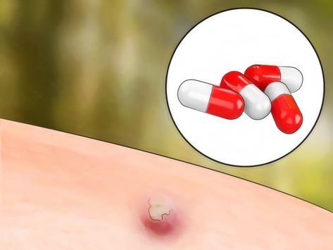 How to Get Rid of Bug Bites. All types of bugs bite — mosquitoes, black flies, horse flies, fleas, mites, chiggers, bedbugs, ticks, etc. — and not a single one of them is any fun. While the bite or sting itself may not be too bad, the swe... Types Of Bug Bites, Black Fly Bites, Bad Bugs, Types Of Bugs, Thanks For The Help, Black Fly, Bug Zapper, Horse Fly, Mosquito Bite