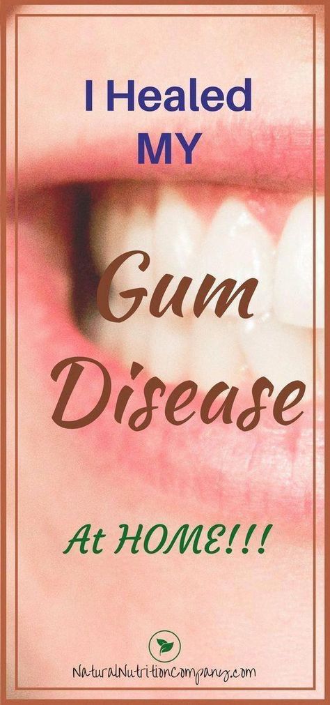 How to treat receding gums at home fast #BestOralCareAdvice #DoesInsuranceCoverOralCare I Healed, Medicine Tips, How To Prevent Cavities, Oral Care Routine, Periodontal Disease, Gum Care, Receding Gums, Gum Health, Oral Health Care