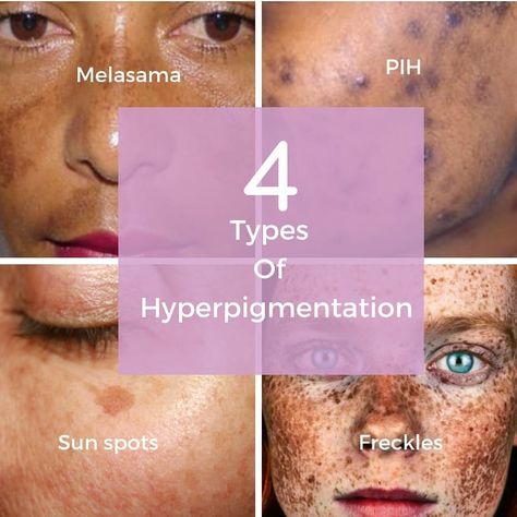 There are 4 main types of hyperpigmentation.  PIH -post inflammatory hyperpigmentation caused by post injury scarring.  Sun Spots - from… Types Of Hyperpigmentation, Post Inflammatory Hyperpigmentation, Skin Hyperpigmentation, Art Of Beauty, Scarring, Skin Clinic, Post Ideas, Esthetician, Healthy Tips