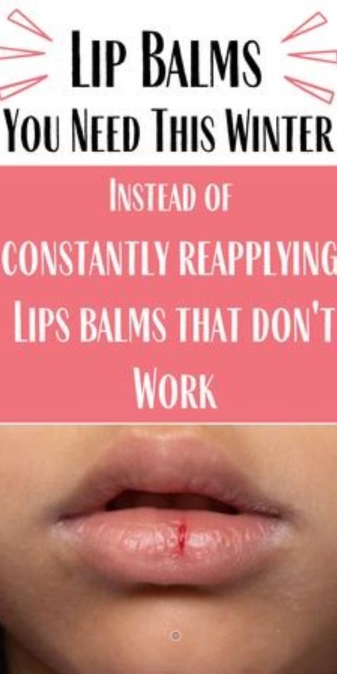 Dry Lips Remedy Overnight, Cut On Lip, Soft Lips Tips, Dry Lips Remedy, Lips Remedies, For Pink Lips, Chapped Lips Remedy, Sunburn Peeling, Lip Gloss Oil