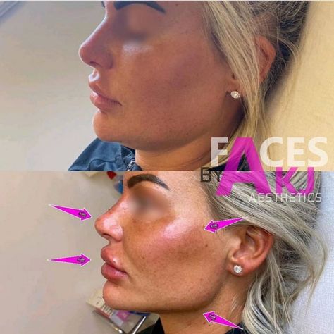 Faces by AKJ Milton Keynes on Instagram: “Bespoke Contouring Package dramatically changing our clients side profile! . Non Surgical Rhinoplasty ✔ Cheek Contouring ✔ Jawline…” Contouring Jawline, Non Surgical Rhinoplasty, Cheek Contouring, Cheek Contour, Milton Keynes, Side Profile, Ear Cuff, Bespoke, Siding