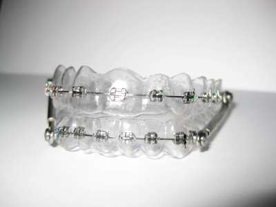 Clear Retainers and Fake Braces Tmj Relief Remedies, Fake Braces, Removable Braces, Fixed Braces, Tmj Relief, Clear Retainers, Adult Braces, Cute Braces, Braces Colors