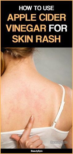 Skin Rash Remedies, Home Remedies For Rashes, Home Remedies For Face, Skin Blisters, Armpit Rash, Rashes Remedies, Apple Cider Vinegar For Skin, Apple Cider Vinegar Benefits, Natural Remedies For Migraines