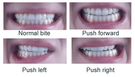 rangeofmotion Double Jaw Surgery Recovery, Jaw Surgery Recovery, Double Jaw Surgery, Jaw Surgery, One Year Later, Year 8, Surgery Recovery, Post Op, 8 Months