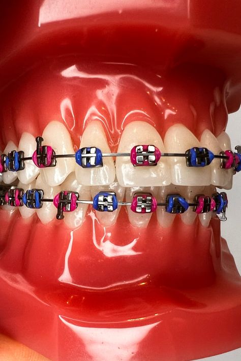 Are you a fan of pink and blue braces? 😍 You're not alone! We've compiled a list of 6 more stunning color combinations to inspire your next smile makeover. From bold and bright to soft and subtle, we have just the right combination to make your teeth stand out and shine. Read the article for more! Pink And Blue Braces, Hot Pink Braces, Teal Braces, Orange Braces, Dark Blue Braces, Light Blue Braces, Dental Braces Colors, Braces Colors Combinations, Blue Braces