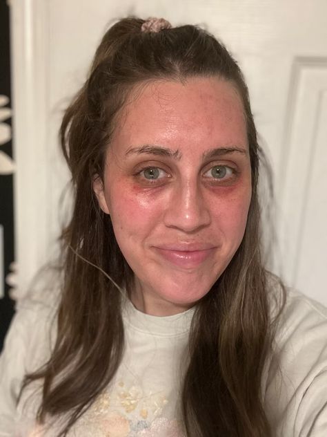 I Tried Microneedling, & My Dark Under-Eye Circles Have Never Looked Better Microneedling With Prp, Dark Under Eye Circles, Dark Eye Circles, Numbing Cream, Dark Circles Under Eyes, Dark Under Eye, Eye Circles, Under Eye Bags, Undereye Circles