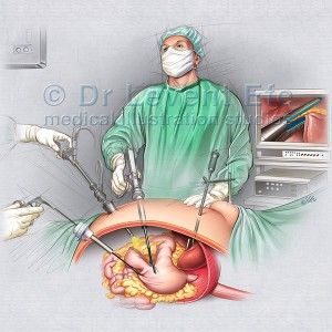 Laparoscopic Sleeve Gastrectomy Endoscopy Procedure, Dubai Video, Bariatric Surgeon, Sleeve Gastrectomy, High Cholesterol Levels, Types Of Surgery, Laparoscopic Surgery, Medical School Studying, Medical Art