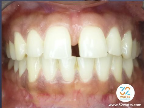 How to close gap in front teeth, teeth gap treatment, how to close gaps in teeth, Big Gaps In Teeth, Front Tooth Gap, How To Close Gap In Teeth, Gap In Front Teeth, Teeth Gap Filling, Gap In Teeth, Gaps In Teeth, Gap Between Teeth, Clear Teeth