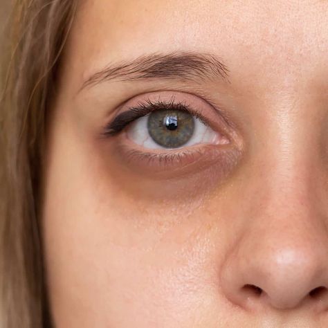 How to Get Rid of Dark Circles Permanently - HealthNile.com Increase Melanin, Dark Circles Under The Eyes, Skin Lightening Cream, Lightening Creams, Under Eyes, Dark Circles Under Eyes, Reduce Dark Circles, Laser Therapy, Chemical Peel