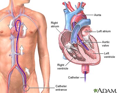 Heart Ablation, Cath Lab Nursing, Ablation Surgery, Cath Lab Nurse, Heart Catheterization, Enlarged Heart, Radiology Student, Cardiac Disease, Heart Muscle