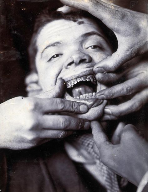 Friern Psychiatric Hospital, Friern Barnet, North London 1890-1910. Young male patient with rotten teeth. Wisdom Teeth Swelling, Celestial Navigation, Tooth Extraction Aftercare, Rotten Teeth, Teeth Whitening Homemade, Mental Asylum, Dental Implants Cost, Crooked Teeth, Haunting Photos